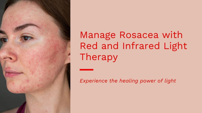 Red and Infrared Light Therapy for Rosacea