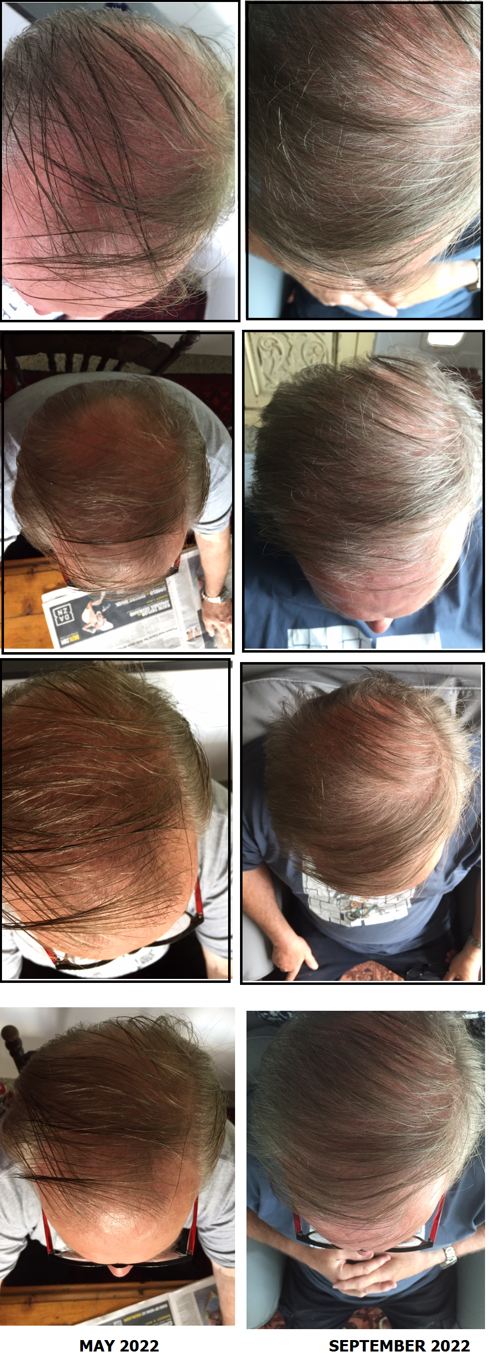 LIGHTFORCE LED RED & INFRARED 5 SPECTRUM HAIR GROWTH CAP